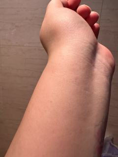 戴了两天这个手链 胳膊被扎的全是红点点😭手链接口部分好像是