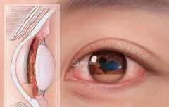 不得不说鳄鱼老师太细节了
恋雪那么美的瞳孔竟然是结核性葡萄膜